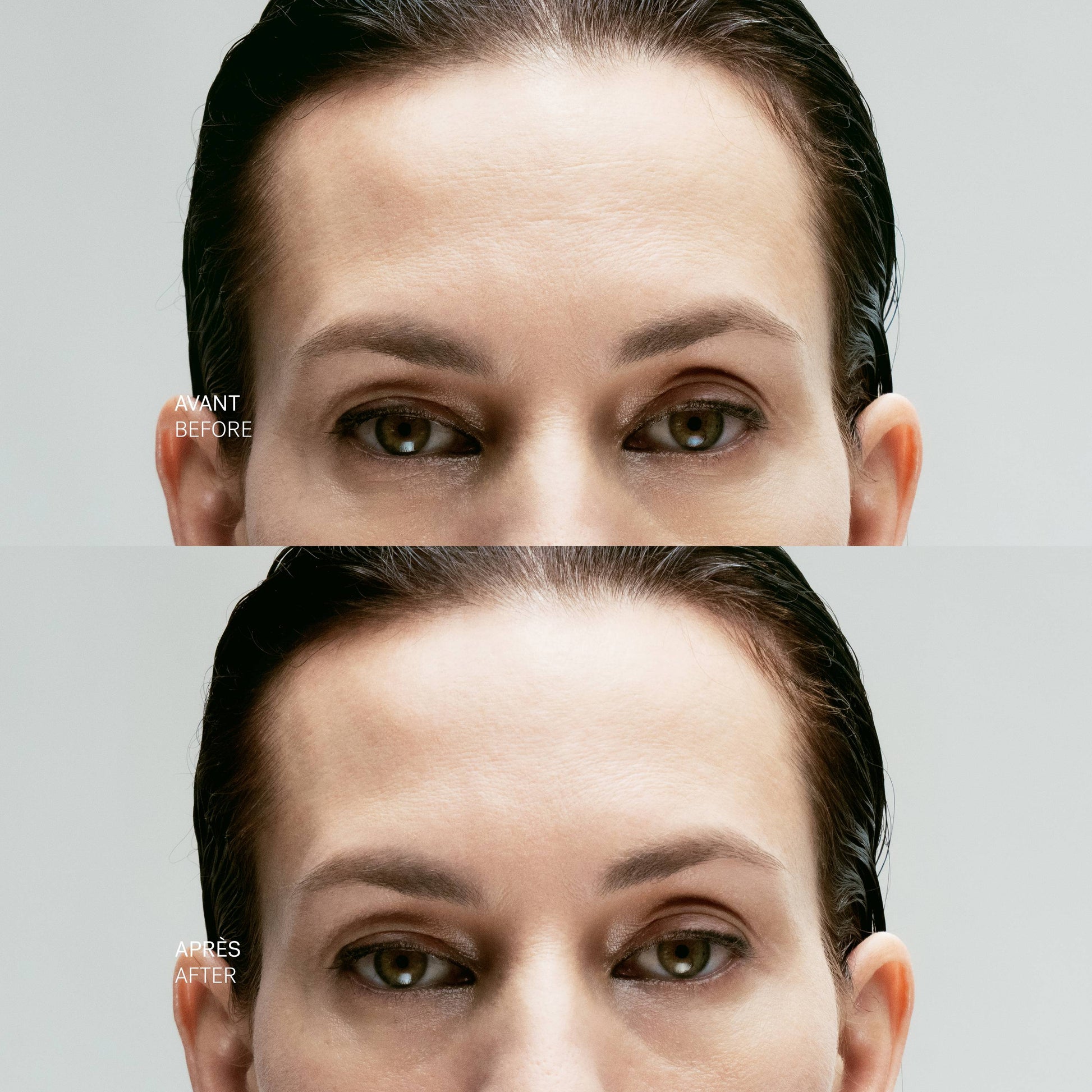 Concentré Local Tenseur A43
Complexe de peptides inhibiteurs 10% + Acide hyaluronique