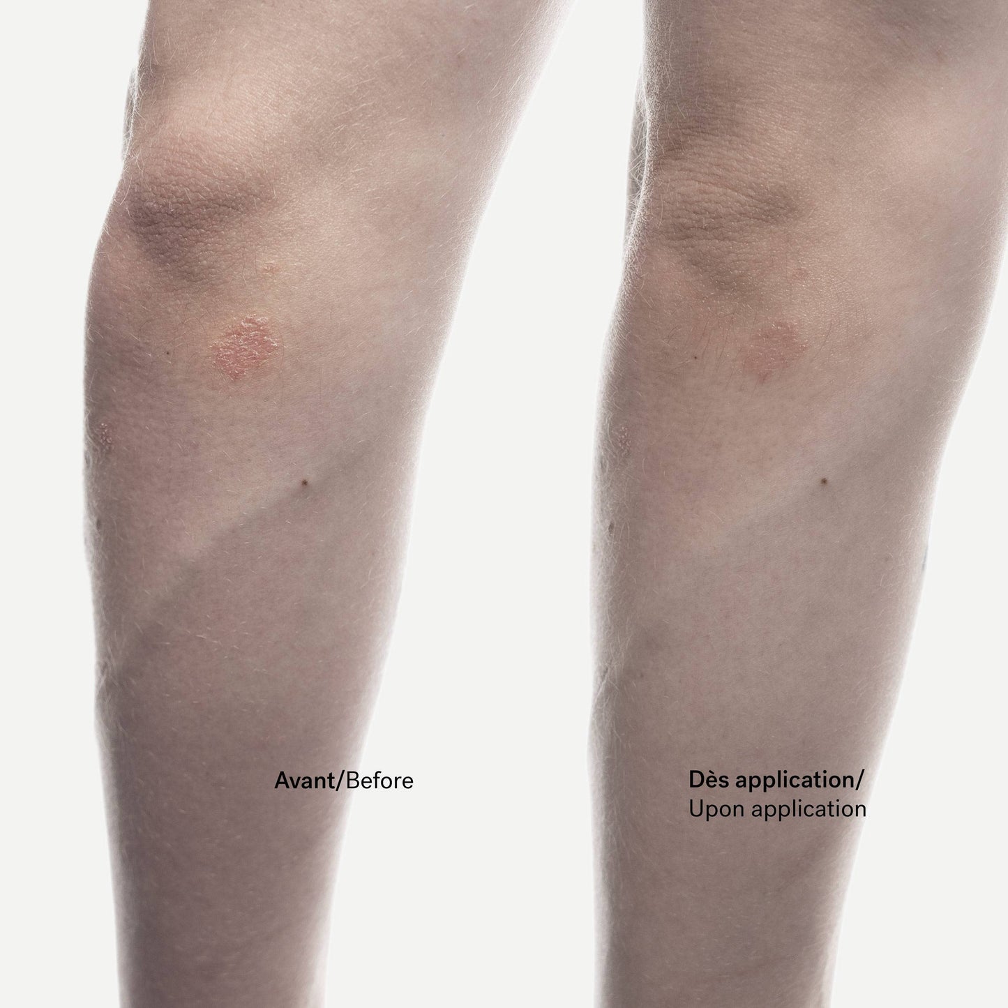Crème Anti-Squames C92
Phytostérols 1% + Allantoïne