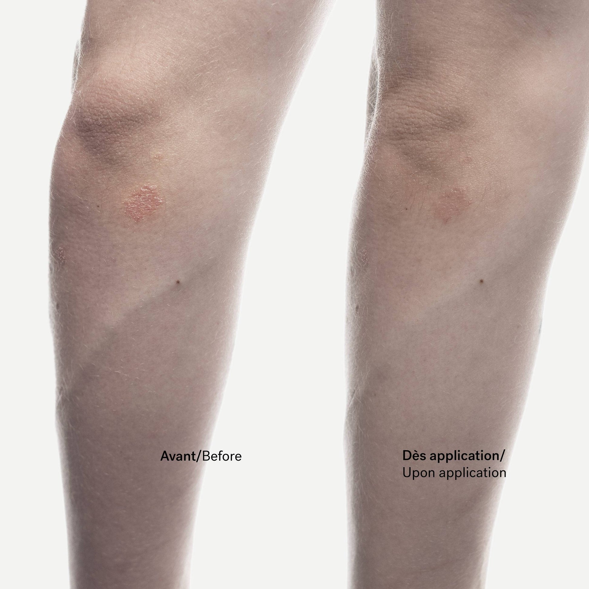 Crème Anti-Squames C92
Phytostérols 1% + Allantoïne
